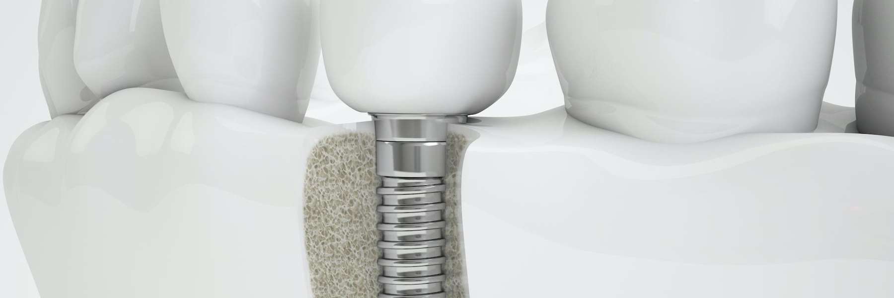 Installed Dental implant in Rehoboth