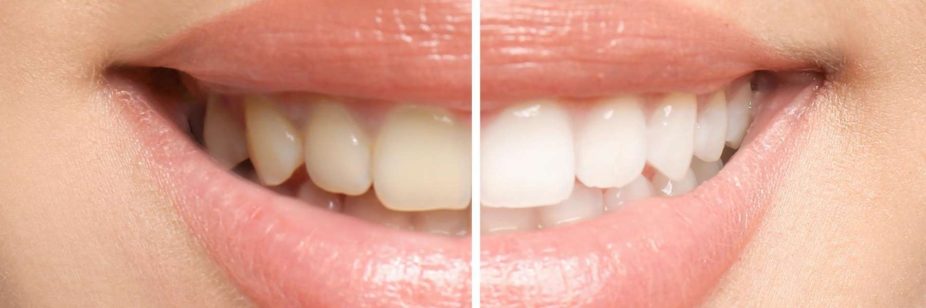 Teeth whitening before and after result in Rehoboth Beach DE