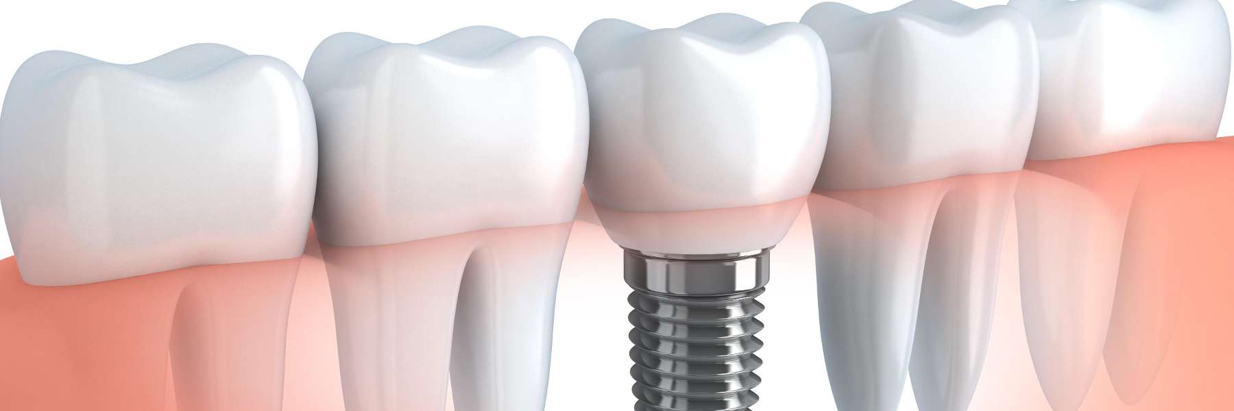 White teeth with dental implants in Rehoboth Beach