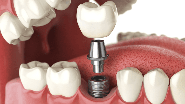 set of dentures with implants in rehoboth beach de