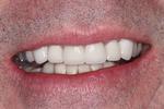 After Anterior Crowns and Veneers at Rehoboth Beach Dental in Rehoboth Beach, DE