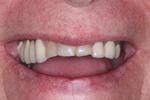 Before porcelian crowns at Rehoboth Beach Dental in Rehoboth Beach, DE