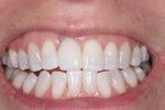 After Implant Crown at Rehoboth Beach Dental in Rehoboth Beach, DE