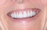 After dental veneers at Rehoboth Beach Dental in Rehoboth Beach, DE