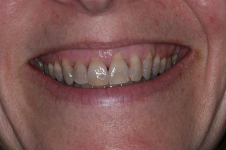 Before dental veneers at Rehoboth Beach Dental in Rehoboth Beach, DE