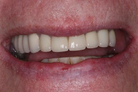 After porcelain crowns at Rehoboth Beach Dental in Rehoboth Beach, DE