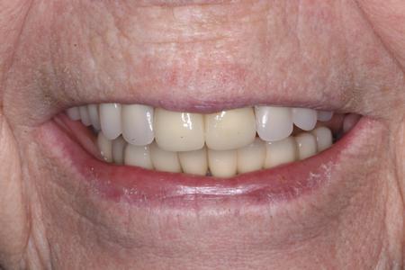 After crowns, new partial denture and reconstruction at Rehoboth Beach Dental in Rehoboth Beach, DE