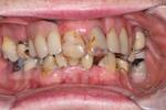Before a full mouth reconstruction at Rehoboth Beach Dental in Rehoboth Beach, DE