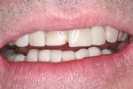 Before crowns and veneers at Rehoboth Beach Dental in Rehoboth Beach, DE