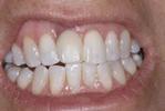 Before implant crown at Rehoboth Beach Dental in Rehoboth Beach, DE