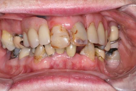 Before a full mouth reconstruction at Rehoboth Beach Dental in Rehoboth Beach, DE