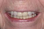 After crowns, new partial denture and reconstruction at Rehoboth Beach Dental in Rehoboth Beach, DE