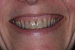 Before dental veneers at Rehoboth Beach Dental in Rehoboth Beach, DE