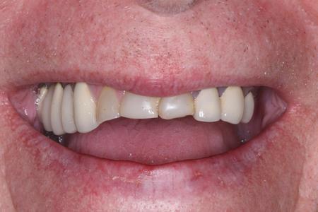 Before porcelian crowns at Rehoboth Beach Dental in Rehoboth Beach, DE